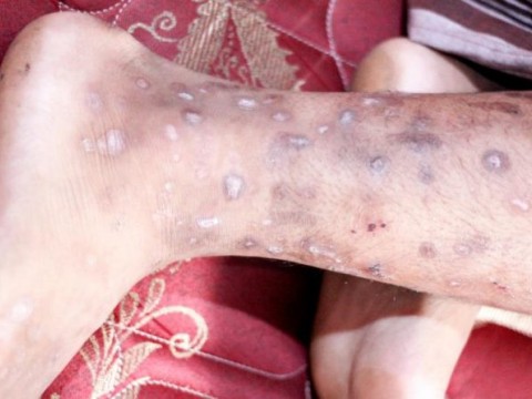 El Dermatol&oacute;gico atendi&oacute; 14,830 casos de sarna en 10 meses