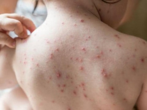 El pa&iacute;s registra 3,693 casos de varicela en lo que va de a&ntilde;o