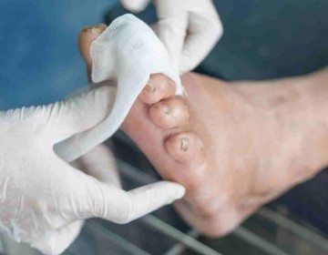 El cuidado de los pies es vital en pacientes con diabetes