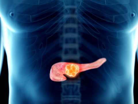 Inteligencia artificial china ayuda a detectar el c&aacute;ncer de p&aacute;ncreas en una fase temprana