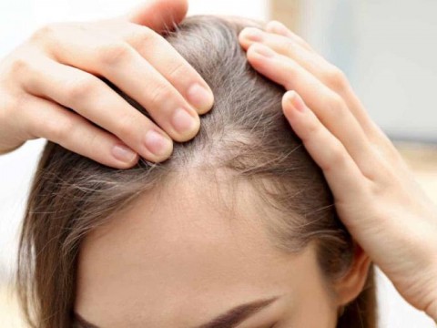 Menos com&uacute;n, pero no imposible: calvicie en mujeres