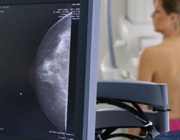 C&aacute;ncer de mama: las desigualdades socioecon&oacute;micas afectan la calidad de vida de las pacientes