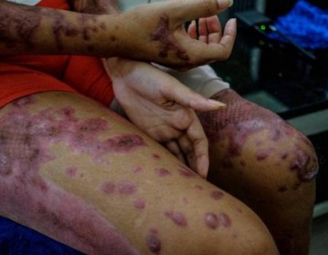 Abinader ayudar&aacute; a Yocairy con sus cirug&iacute;as reconstructivas
