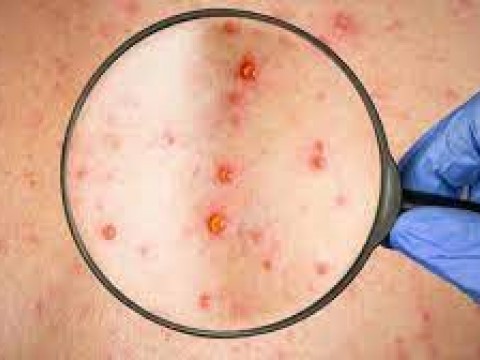 Estados Unidos detecta varios casos sospechosos de viruela del mono