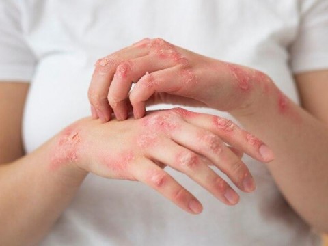 Dermatol&oacute;gico asiste actualmente a 205 pacientes por lepra